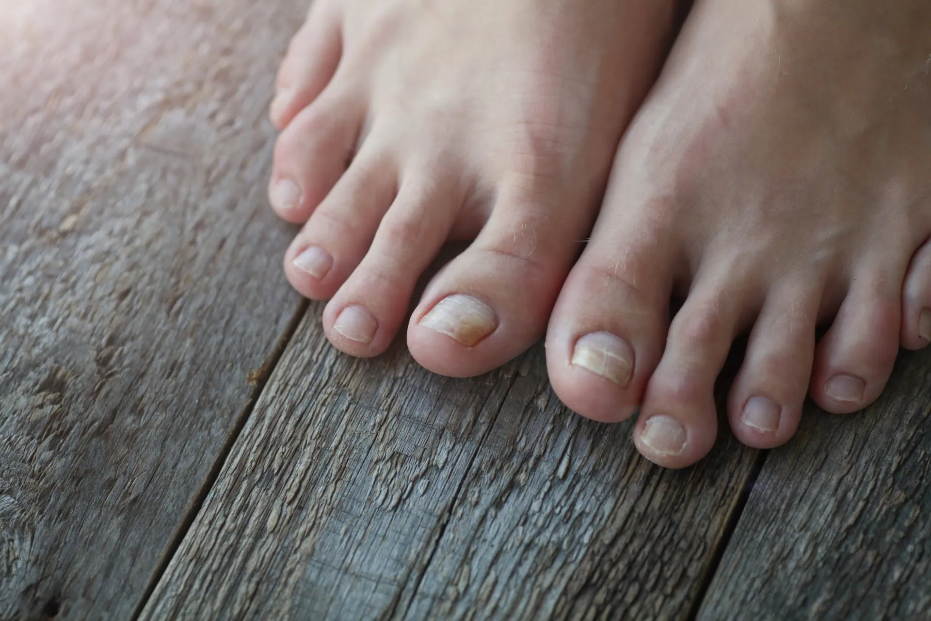 Omas Hausmittel gegen Nagelpilz